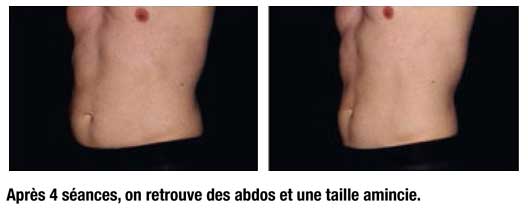 Em Sculp abdos taille amincie Em Sculp abdos taille amincie