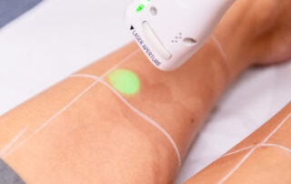 epilation-laser-fonctionnement