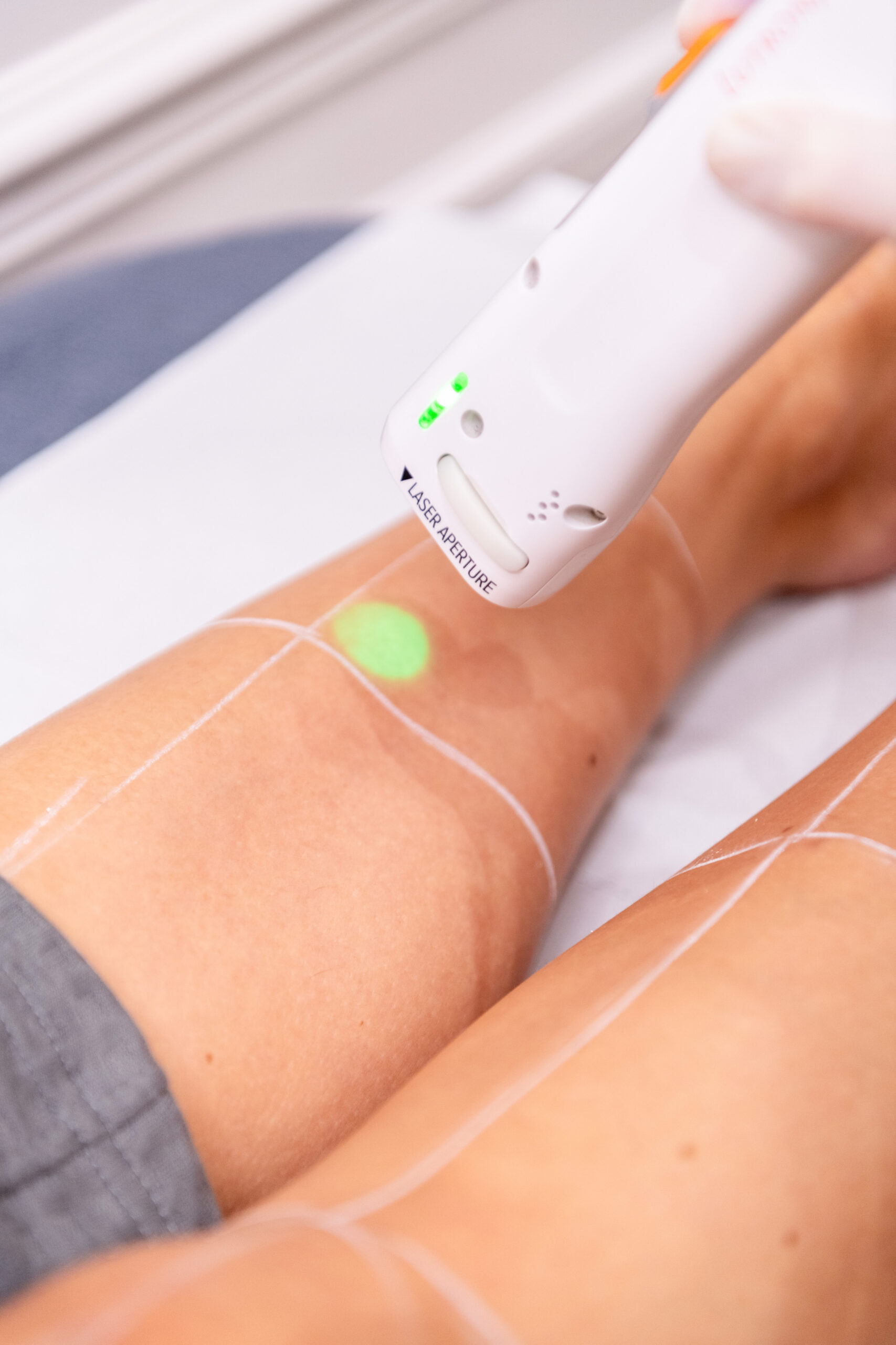 epilation-laser-fonctionnement